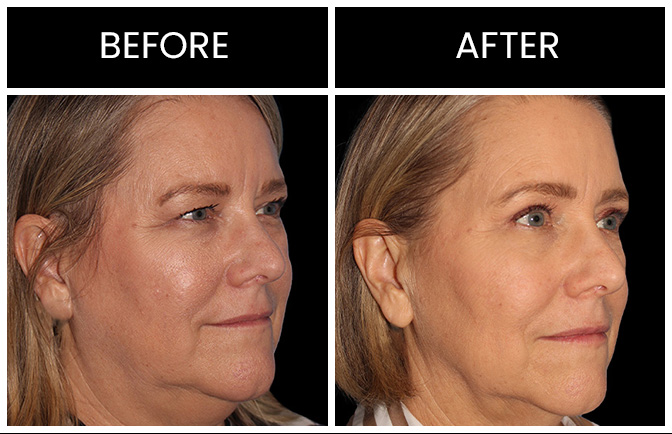 Atlanta CO2 Laser Skin Resurfacing Results